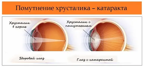 Сколько стоит катаракта?